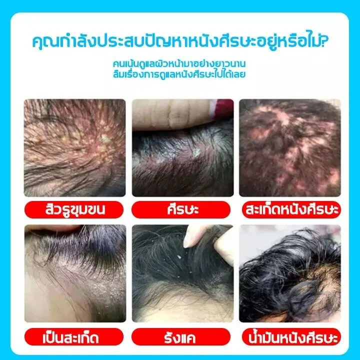 ขจัดเหาถึง100-แชมพูกำจัดเหา-120ml-กำจัดถึงต้นตอ-เหาตาย-ไข่หลุด-แก้คัน-สมุนไพร100-แชมพูเด็ก-ยากำจัดเหา-กำจัดเหา-ไข่เหา-กลิ่นหอม-อ่อนโยน-ยาฆ่าเหา-แชมพูเหา-ยาฆ่าเหาถาวร-กำจัดเหา-บรรเทาอาการคัน-ยาฆ่าเหาถา