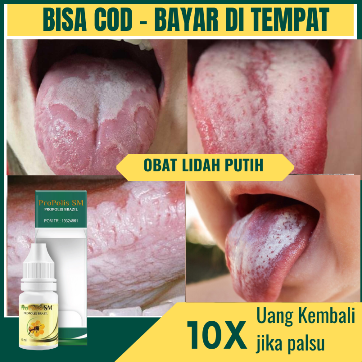 Obat Lidah Putih Lidah Berjamur Oral Thrush Kandidiasis Oral