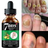 7DAYS Repair Nail Fungus Treatments Essence Foot Care Serum Toe Nails Fungal Removal Gel Anti Infection Onychomycosis