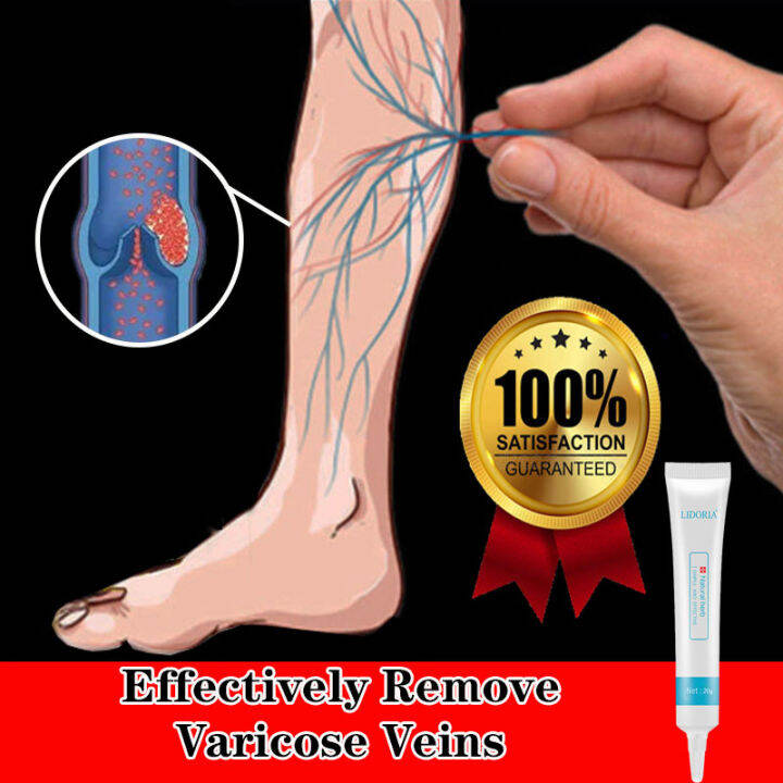 Varicose Vein Cream Effective Anti Varicose Veins Ointment 20G | Lazada