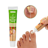 ครีมรักษาเชื้อราที่เล็บกำจัดเล็บ Paronychia Onychomycosis Ointment Feet Whitening Toe Care Plaster Support