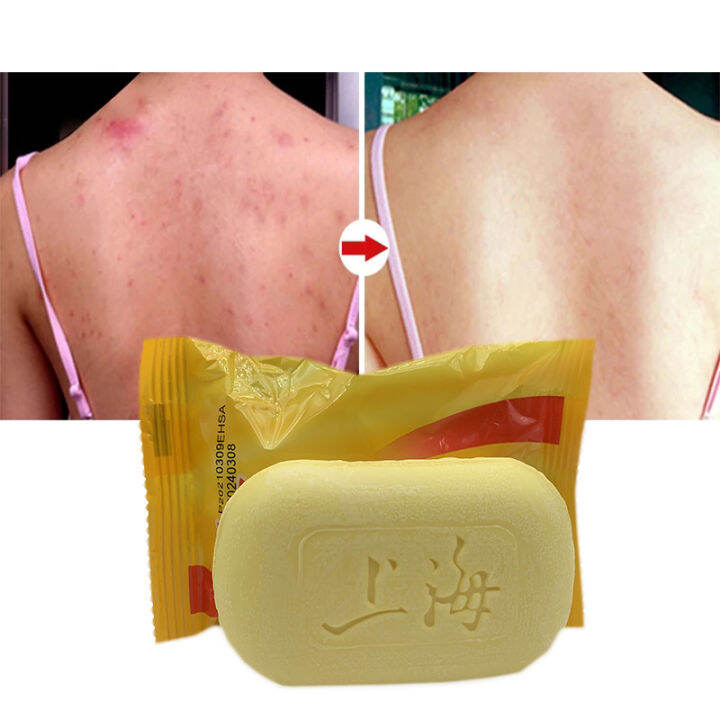 Shanghai Sulfur Soap Oil Control Acne Treatment Psoriasis Seborrhea Eczema Anti Fungus Bath