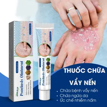 Top sản phẩm cream for eczema hiệu quả và an toàn cho da