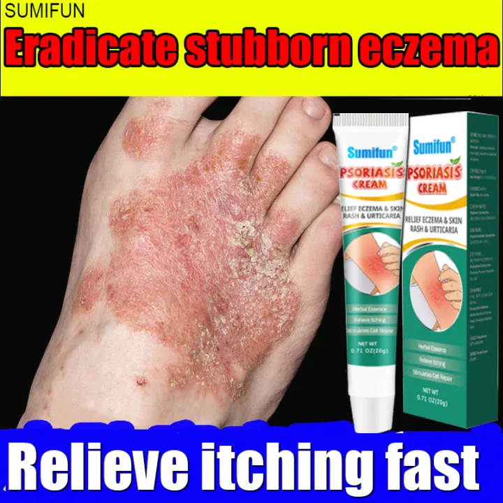 ⚡️Relieve itching fast⚡️Antibacterial Cream Eczema Ointment safe all ...