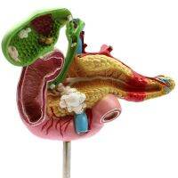 ENOVO hs medical pancreas duodenum gallbladder pathologic model surgical digestive system