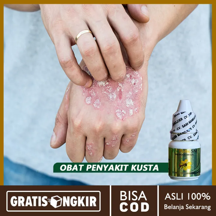 Obat Penyakit Kusta, Lepra, Obat Kusta Ditangan, Kusta Basah, Kusta ...