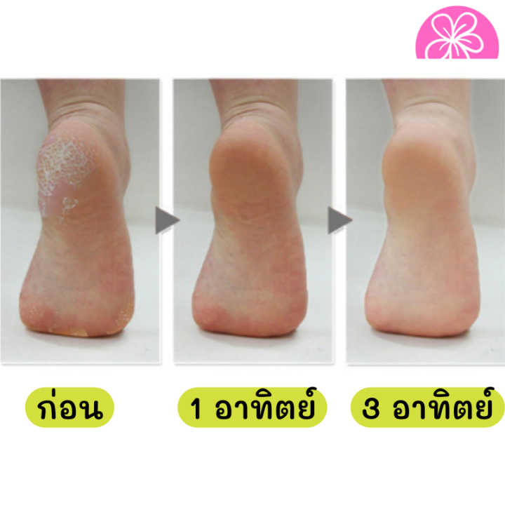 ซื้อครีม-แถมฟรี-ชุดขูดส้นเท้าแตกด้ามไม้-ครีมบำรุงส้นเท้าแตก-ครีมบำรุงเท้า-ครีมทาเท้า-ครีมทาส้นเท้า-ที่ขัดส้นแตก