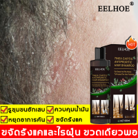 ป้องกันรังแคและคัน ไม่ทำร้ายหนังศีรษ แชมพูขจัดรังแค100ml ควบคุมความมัน ขจัดรังแค บำรุงรากผม ลดผมร่วง（ดูแลหนังศีรษะ แชมพู แชมพูรักษารังแค ยาสระผมเชื้อรา แชมพูแก้ผมหงอก บำรุงหนังศีรษะ ยาสระผมแก้เชื้อรา แชมพูคัน ลดรังแค ยาสระผม ยาสระผมเชื้อรา มีรังแค）