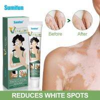 Sumifun ครีมจุดสีขาวสำหรับครีมโรคด่างขาว Mycosis การรักษา Leukoplasia บำรุงผิวกาย20กรัม