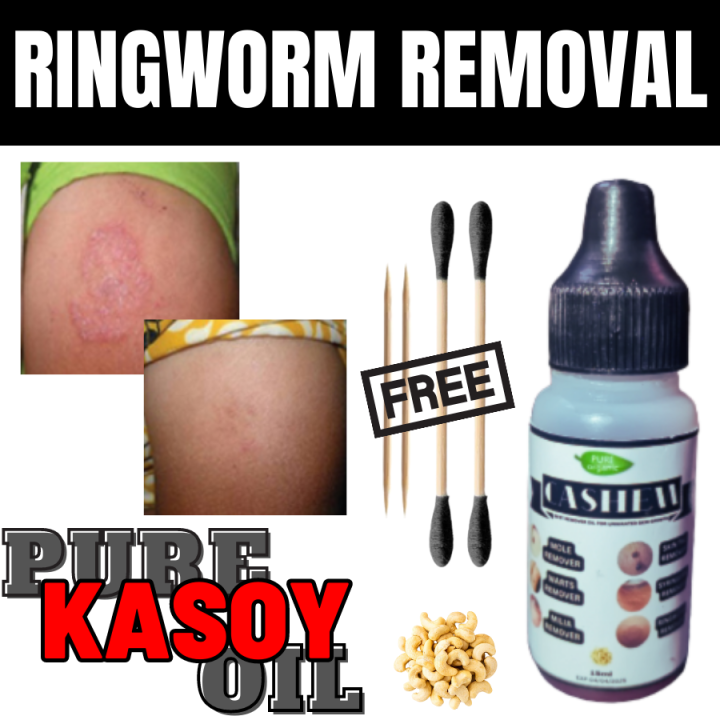 RINGWORM REMOVAL CASHEW OIL , ringworm , ringworm removal ointment , ringworm treatment for