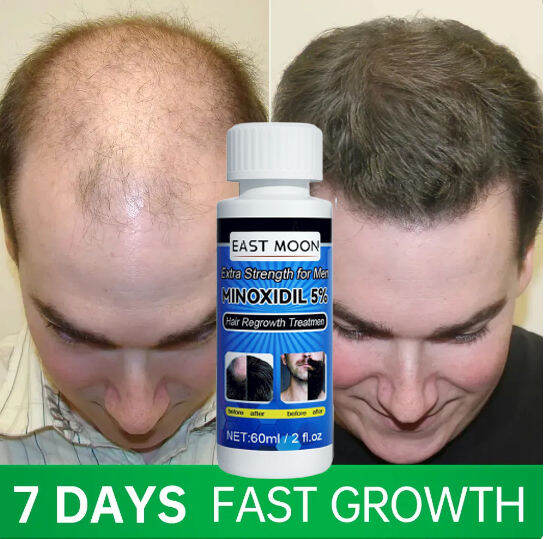 Minoxidil 5% Hair Grower For Men Original Hair Treatment Anti Loss Hair ...