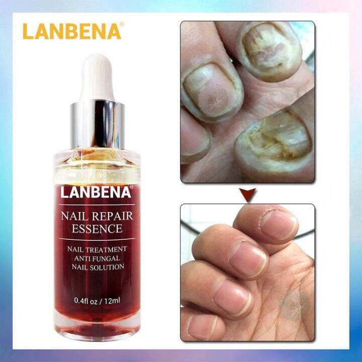 lanbena-nail-repair-essence-serum-fungal-nail-treatment-remove-onychomycosis-toe-hand-foot-skin-care