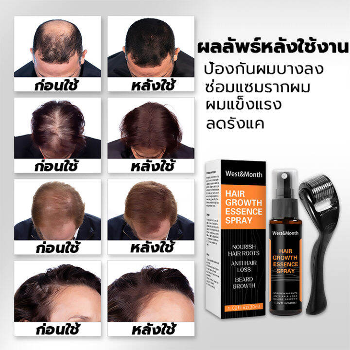 ทำให้ผมยาวขึ้นอย่างรวดเร็ว-สเปรย์ปลูกผม-30ml-ลูกกลิ้ง-ใช้คู่กัน-ได้ผลลัพธ์2เท่า-ป้องกันผมร่วง-ปลูกผมเร่งด่วน-ยาปลูกผม-น้ำยาใส่ผม-เซรั่มปลูกผม-น้ำยาเร่งผมยาว-ปลูกผม-ยาปลูกผมของแท้-hair-growth