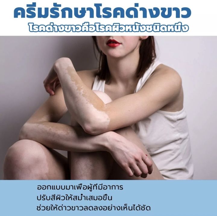 herbal-extract-vitiligo-ส่งทันที-south-moon-ครีมทาด่างขาว-ด่างขาวที่หน้า-ด่างขาวที่หลัง-ด่างขาวที่แขน-ด่างขาวที่ตัว