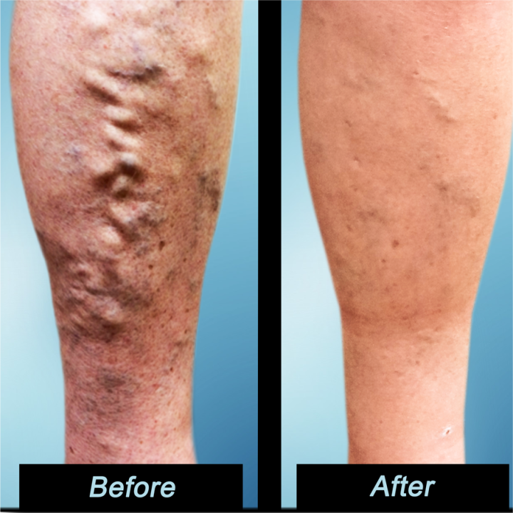 Varicose veins, earthworm leg pain, itching, blue tendons, bulging