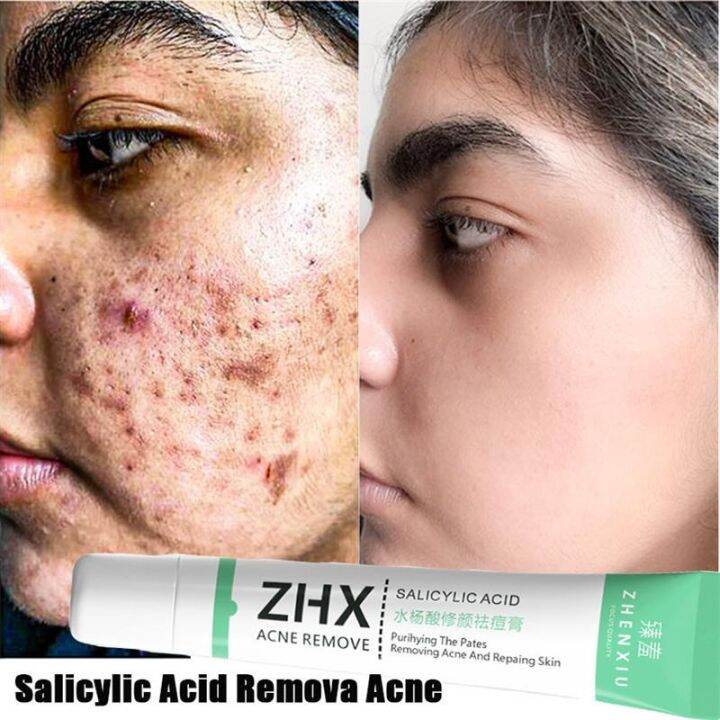 New 2023 salicylic acid acne treatment cream shrink pore improve acnes