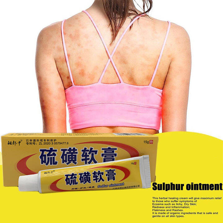 Eczema Treatment Cream Ointments for Dermatological Diseases Psoriasis