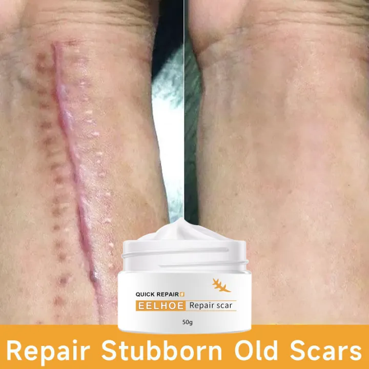 50g Original EELHOE Remover Cream for Burn Scar,Old Scar on Leg,Acne