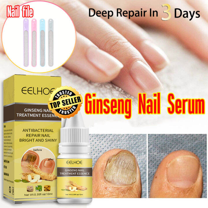 【Effective In 3 Days】Nail Fungus Treatment Nail Repair Quickly Repair