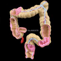 Colorectal lesion model human colon large intestine pathological diseases model medical organizer anatomy 14x17x21cm Drills Drivers