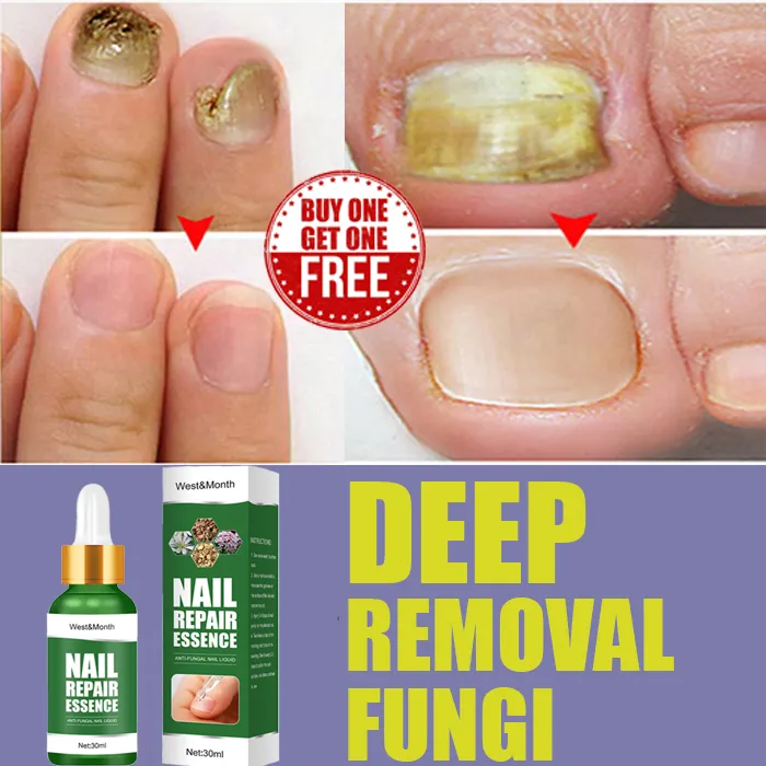 buy 1 take 1]Nail repair essence Nail care fix nail onychomycosis nail  fungus treatment nail