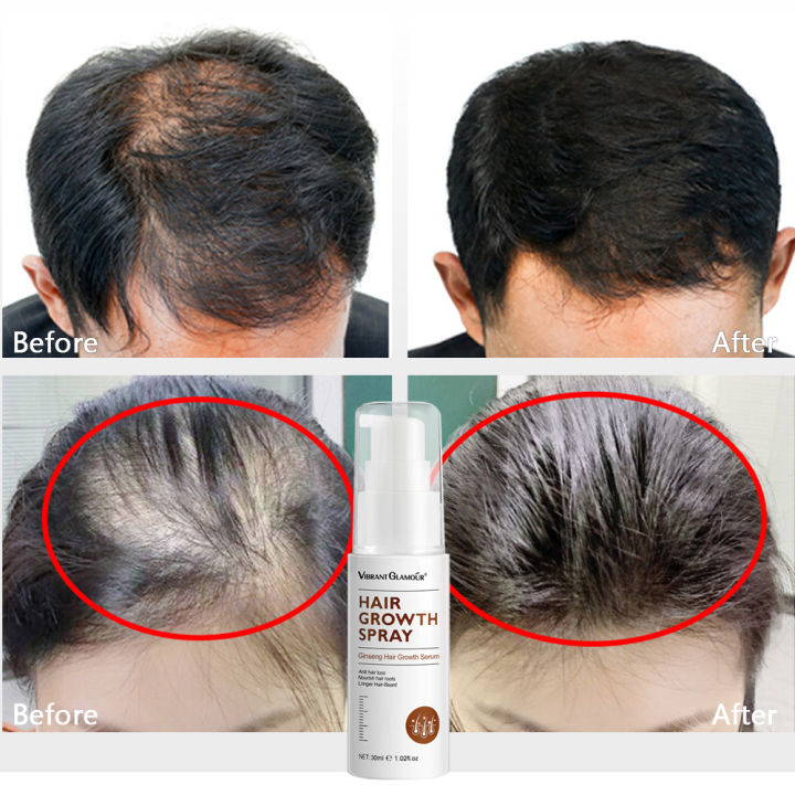 Ngăn rụng tóc Bạn đang cảm thấy lo lắng về tình trạng rụng tóc của mình? Sử dụng sản phẩm ngăn rụng tóc chuyên biệt để tóc bạn trở nên khỏe mạnh hơn. Hãy xem hình ảnh liên quan để tìm hiểu thêm về sản phẩm này!