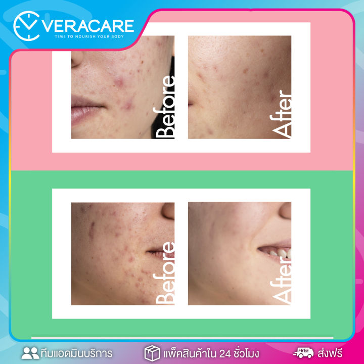 vc-เจลเเต้มสิว-cathy-doll-2-step-acne-care-เคที่ดอลล์-แอคเน่-แคร์-ชุดเจลแต้มสิว-เจลแต้มรอยสิว-ผลิตภัณฑ์ดูแลผิวหน้า-เจลทาสิว-ครีมทาสิว