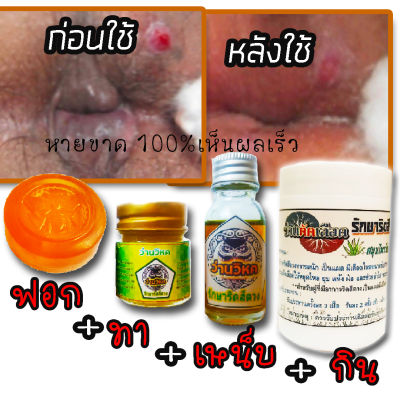 น้ำมันว่านวิหค เซ็ต4สหาย ริดสีดวงยุบฝ่อเหี่ยวแห้งสนิทแค่ใช้ สบู่+ครีม+น้ำมันว่าน+ลูกกลอนว่านวิหคสมุนไพรไทย ผิวทุกประเภท