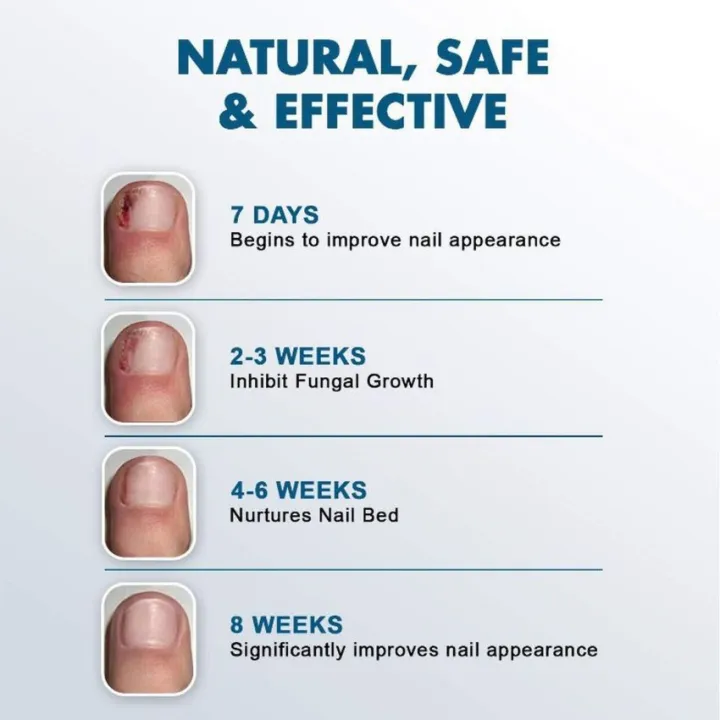 Nail Nutrient Solution Onychomycosis Removal Nail Water Repair Fluid Nail Removal Onychomycosis