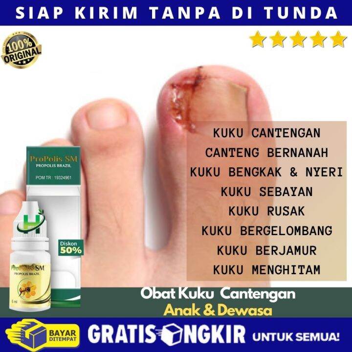 Obat Jamur Kuku Tangan, Obat Kuku Bergelombang, Kuku Keongan, Kuku