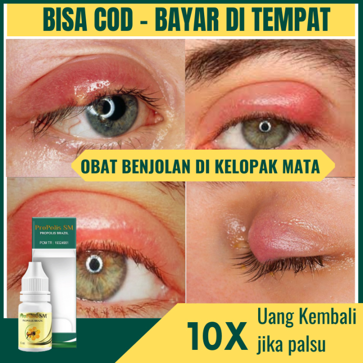 Obat Benjolan Di Kelopak Mata, Obat Benjolan Kalazion, Obat Oles Mata ...