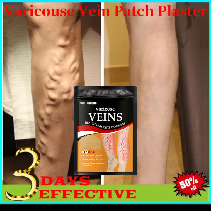 100% Effective Original Varicouse Varicose Vein Patch Plaster (12pcs ...