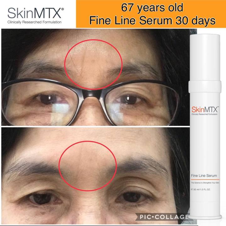 skin-mtx-fine-line-serum-30ml-เซรั่มสำหรับลดเลือนริ้วรอยแห่งวัย-ช่วยให้ริ้วรอยแลดูตื้นขึ้นด้วยเป็ปไทด์-ประเภทเดียวกับโบท็อกซ์-skinmtx-ริ้วรอยตื้น