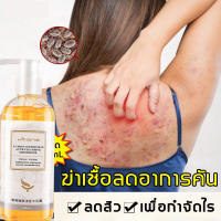 ครีมอาบน้ำกำจัดไร260ml เจลอาบน้ำ shower gel ครีมอาบน้ำลดสิว ขจัดไรและสิว บอกลาผิวหยาบกร้าน อ่อนโยนไม่ระคายเคือง