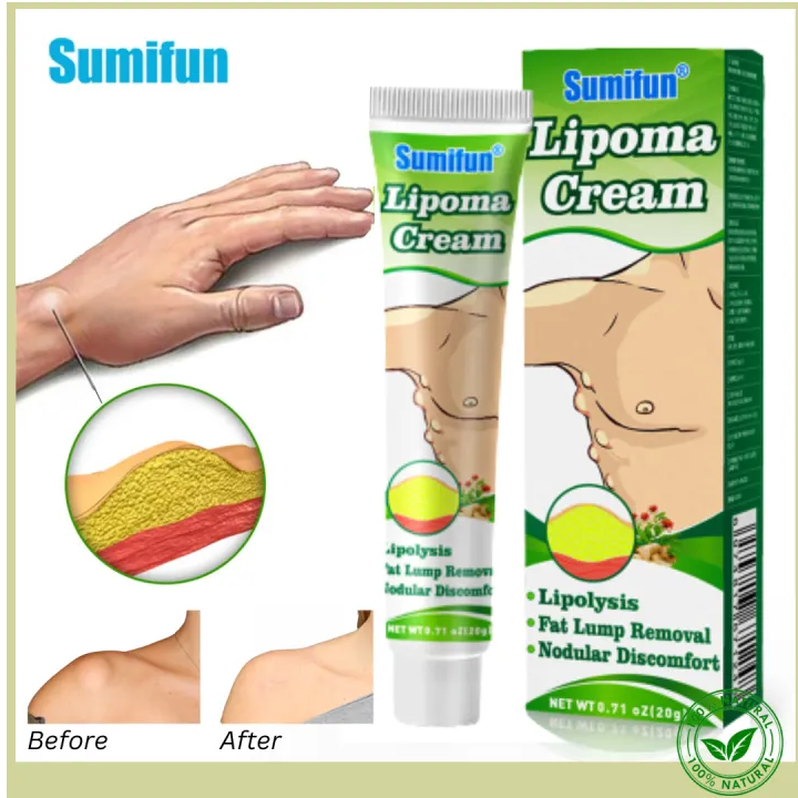 12. 1pc 20g 🔥 ️😍👑👸EFFECTIVE!! ON HAND!! Sumifun Lipoma Removal Skin ...