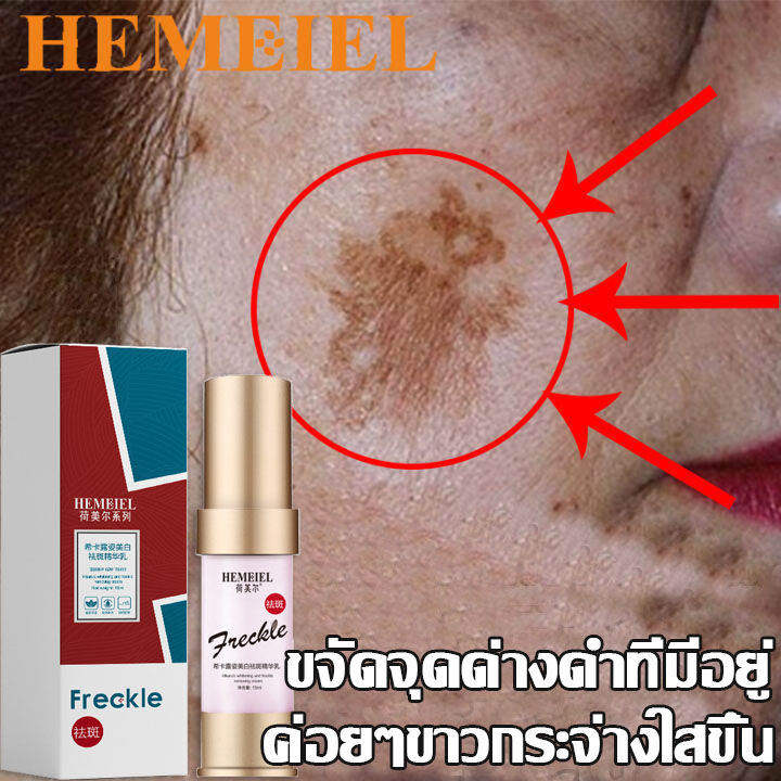 hemeiel-ครีมแก้ฝ้าแท้ๆ-ลดเม็ดสีเมลานิน-ยับยั้งกระบวนการสร้างเมลานิน-กำจัดฝ้า-กระ-ให้ผิวสวยกลับมา