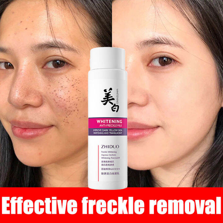 Melasma and pekas remover 120ML nicotinamide freckle remover pekas ...