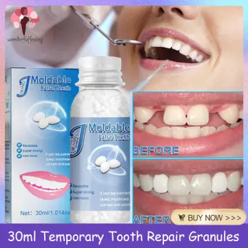 30ml Temporary Tooth Repair Kit, Temporary Filling Teeth Thermal Beads for  Filling Fix The Missing and Broken Tooth 