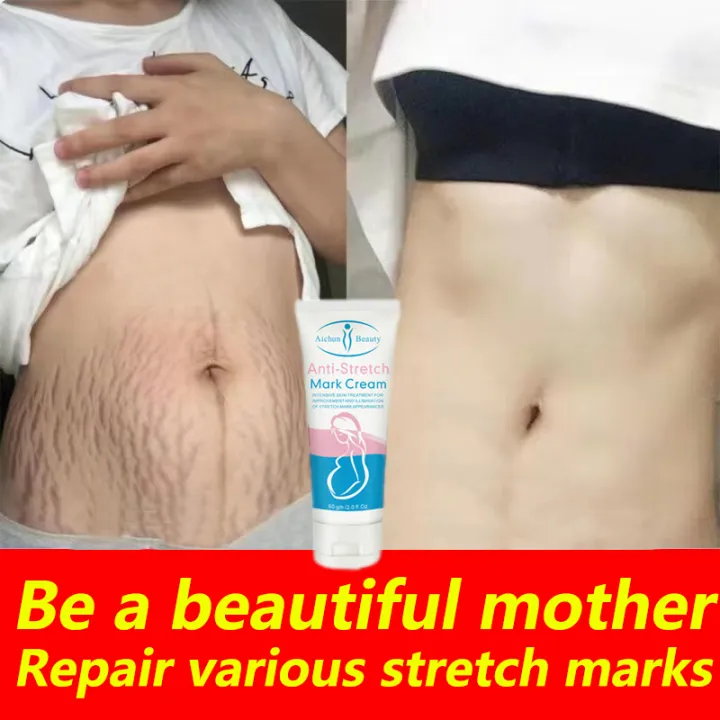 Postpartum Stretch Marks Repair Cream