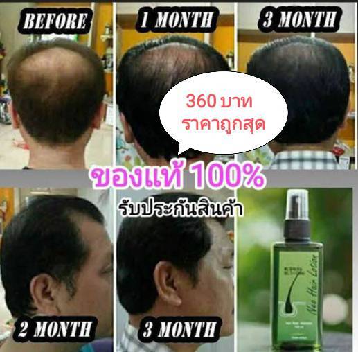 ของแท้-โปรโมชั่น-2-แถม-1-neo-hair-lotion-แถมฟรี-roller-ส่งด่วนทุกวัน-ของแท้-100-นีโอแฮร์โลชั่น-neohair-ส่งตรงจากโรงงาน