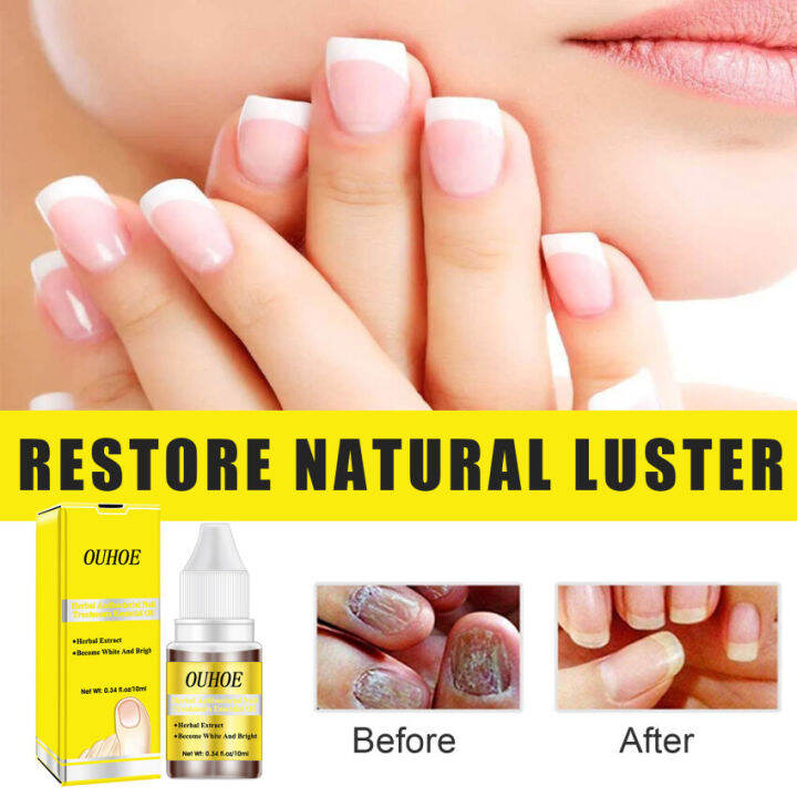 Nail Fungus Removal Serum Foot Care Treatment Antiseptic Nail Fungus ...