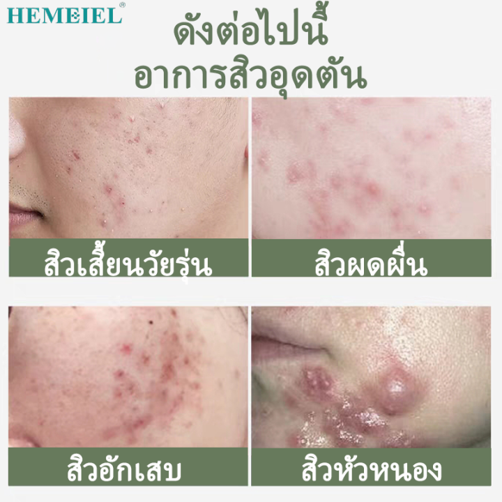 hemeiel-แต้มสิว-เจลละลายสิว-ที่แปะสิว-ซ่อมแซมผิวให้เรียบเนียนมากขึ้น