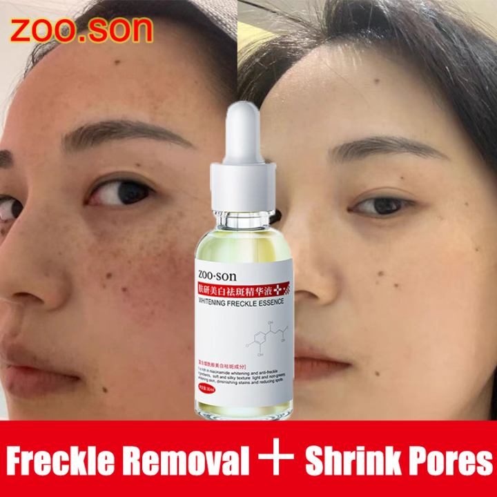 Original Melasma Serum Remover Melasma And Pekas Remover Serum Original Melasma Serum Remover Melasma And Pekas Remover Serum