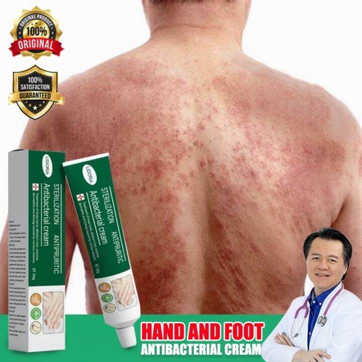 Atoderma cream anti fungal cream eczema psoriasis cream ointment eczema