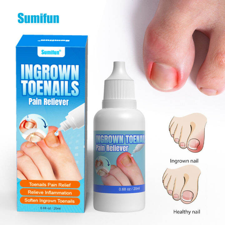Sumifun 20ml Ingrown Toenails Pain Reliever Deep Toenail Pain Relief、Inflammation