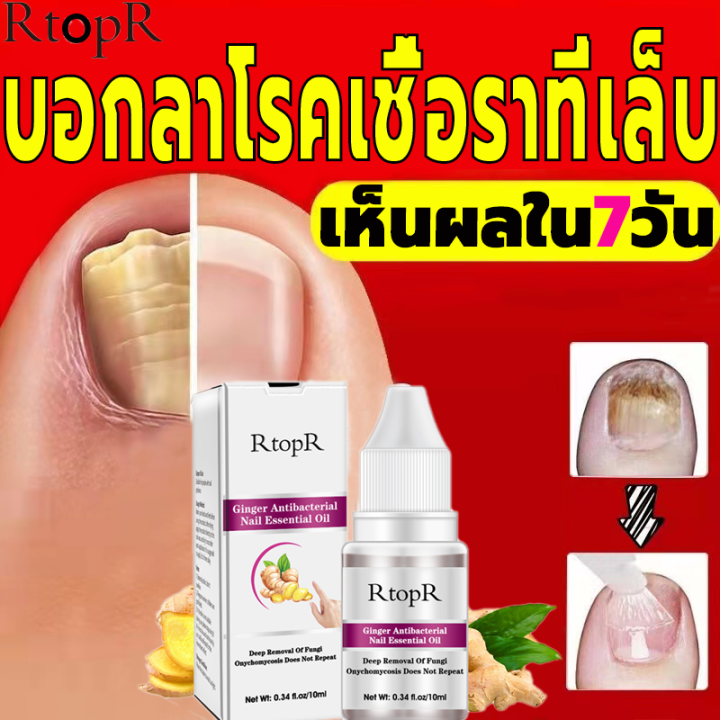 เห็นผลภายใน7วัน-rtopr-รักษาเล็บ-เล็บเท้าคุณภาพสูงกำจัดเชื้อราที่เล็บ-เอ็สเซ้นซ่อมแซมเล็บเสีย-รักษารคเชื้อราที่เล็บ-เล็บพัง-เล็บขบ-เซรั่มบำรุงเล็บ-น้ำมันบำรุงเล็บ-ดูแลเล็บ-เชื้อราเล็บมือ-น้ำยารักษาเล็บ