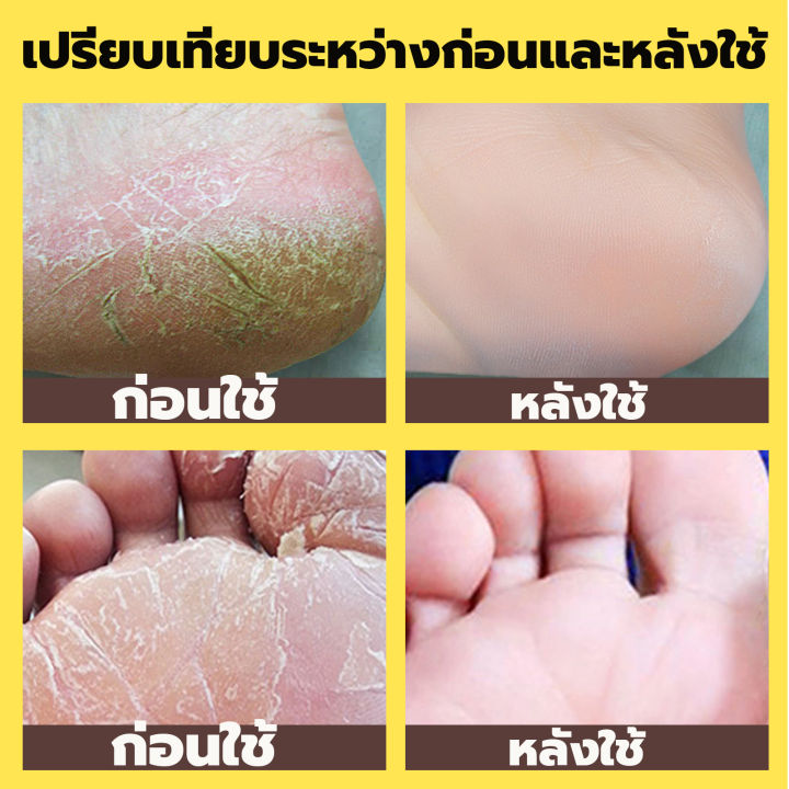 eelhoe-สเปรย์ฉีดเท้า-50ml-ครีมทาเท้าขาว-ทาเท้าคัน-ครีมทามือ-ครีมนวดเท้า-บรรเทาอาการคัน-ผิวเท้านุ่มเนียน-ครีมทาเท้าแตก-ครีมทาส้นแตก-ครีมส้นเท้า-ครีมทาส้นเท้า-ครีมดูแลเท้า-ครีมบำรุงเท้า-ดูแลมือ-โลชั่นทา