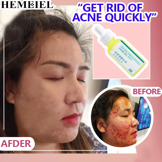 HEMEIEL Pimple Eraser Quick Fx/Acne Remover/Anti Acne And Pimples ...