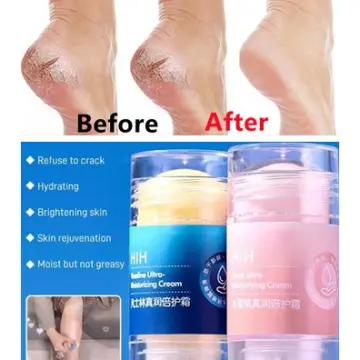 How to Prevent Cracked Heels? - Dr Venus