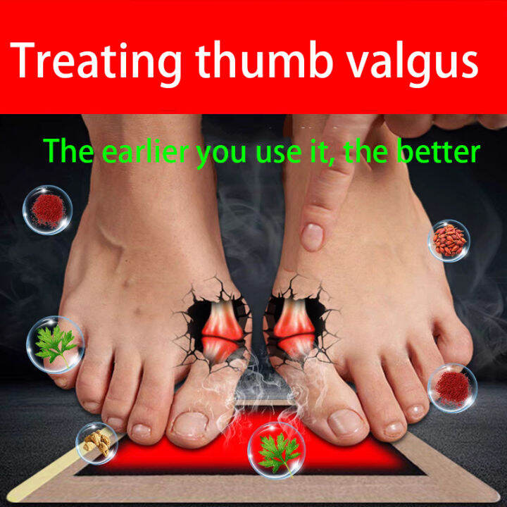 Herb Bunion Pain Relief Cream Hallux Valgus Toe Knee Leg Joint Pain